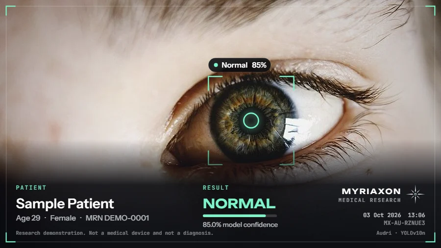 A report image from the cataract demo: a close-up eye with a marker ring, the result Normal at 85% confidence, a fictional patient label and the Myriaxon signature.